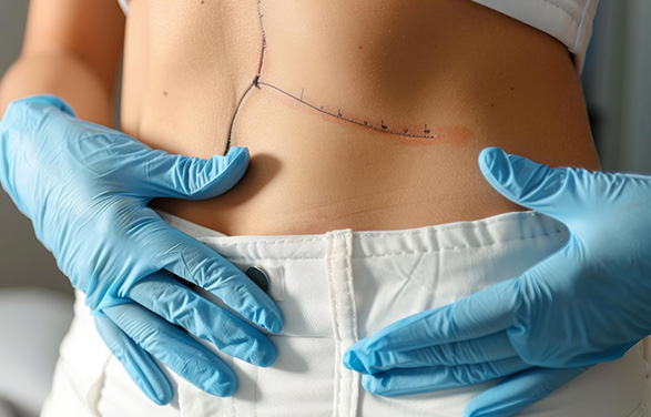 Scars Surgery in Ahmedabad 1