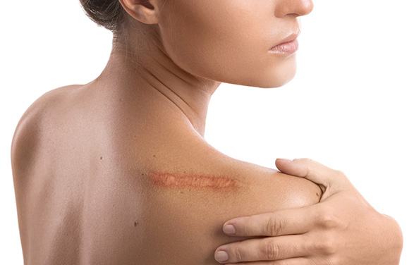 Scars Surgery in Ahmedabad