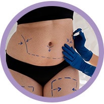 liposuction surgery in ahmedabad